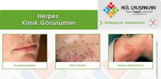 Herpes Enfeksiyonları