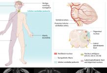 Wallenberg Sendromu Acil Yaklaşım