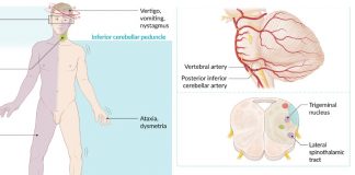 Wallenberg Sendromu Acil Yaklaşım