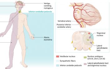 Wallenberg Sendromu Acil Yaklaşım
