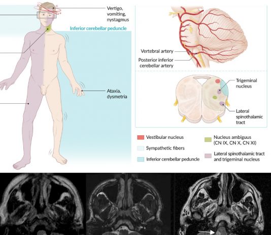 Wallenberg Sendromu Acil Yaklaşım