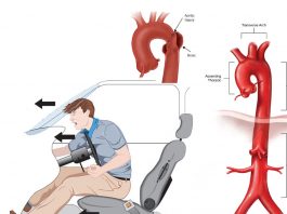 Aort Travmalarına Acil Yaklaşım