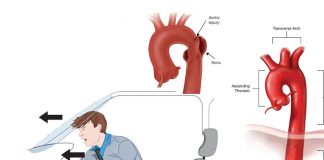 Aort Travmalarına Acil Yaklaşım