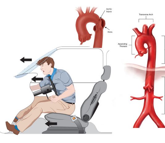 Aort Travmalarına Acil Yaklaşım