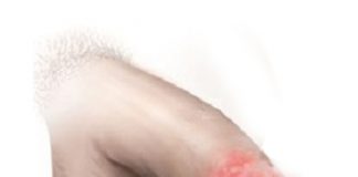 Balanit Acil Yaklaşım