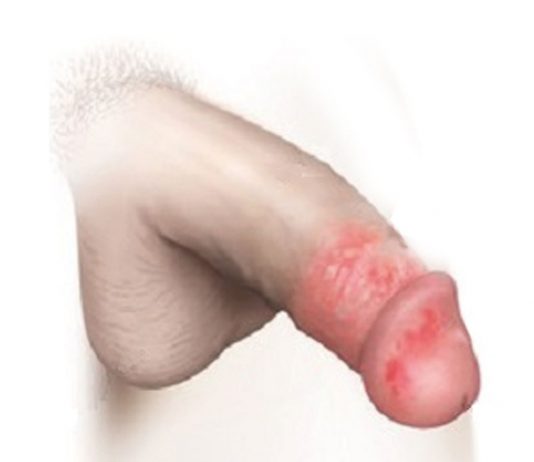 Balanit Acil Yaklaşım