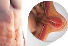 Karın Duvarı Hernilerine Acil Yaklaşım