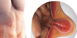 Karın Duvarı Hernilerine Acil Yaklaşım