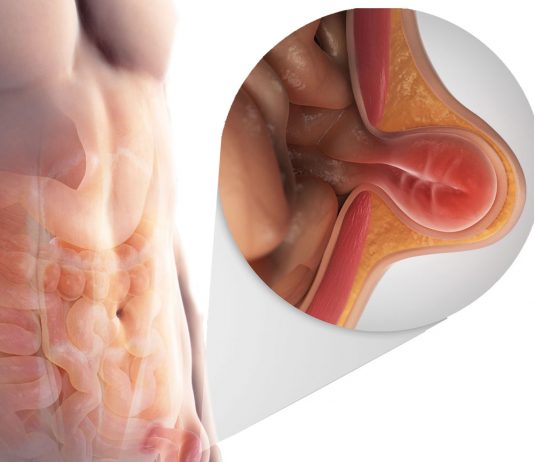 Karın Duvarı Hernilerine Acil Yaklaşım