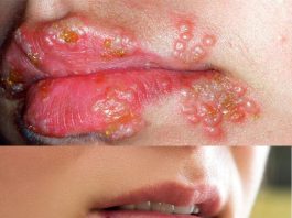 Herpes Labialis (Uçuk)