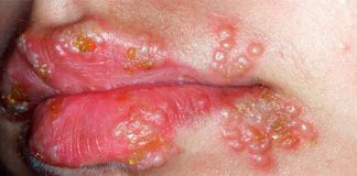 Herpes Labialis (Uçuk)