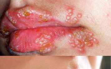 Herpes Labialis (Uçuk)