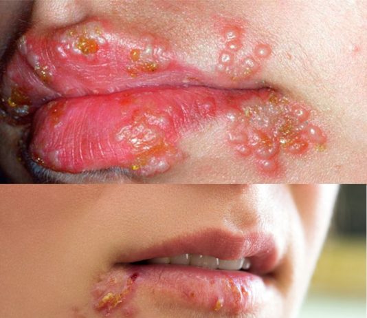 Herpes Labialis (Uçuk)