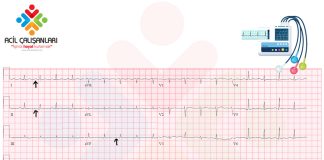 Elektriksel Alternans