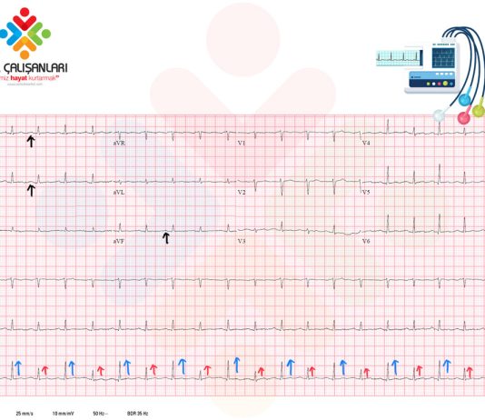 Elektriksel Alternans