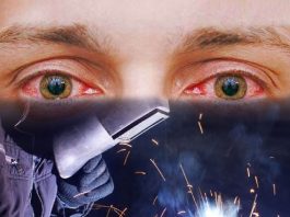 Gözü Kaynak Alması (Fotokeratit) Acil yaklaşım