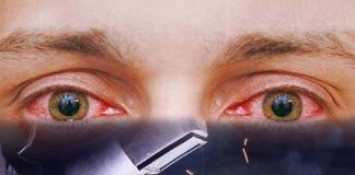 Gözü Kaynak Alması (Fotokeratit) Acil yaklaşım