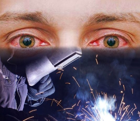 Gözü Kaynak Alması (Fotokeratit) Acil yaklaşım