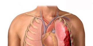 Hemotoraks Acil Yaklaşım