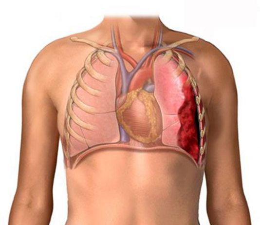 Hemotoraks Acil Yaklaşım