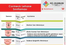 Cormeck Lehane Sınıflaması Akıl Kartı