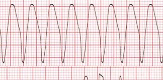 Geniş Kompleks Taşikardiler