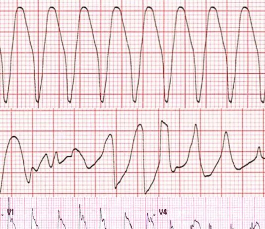 Geniş Kompleks Taşikardiler