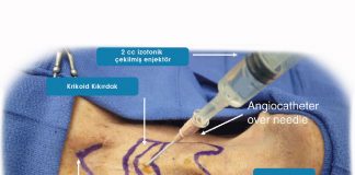 İğne Krikotirotomi