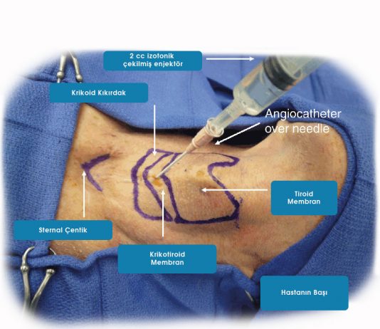 İğne Krikotirotomi