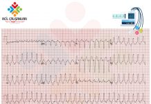 Ventriküler Taşikardi (VT) ile Aberran İletili SVT Ayrımı