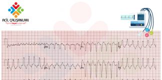 Ventriküler Taşikardi (VT) ile Aberran İletili SVT Ayrımı