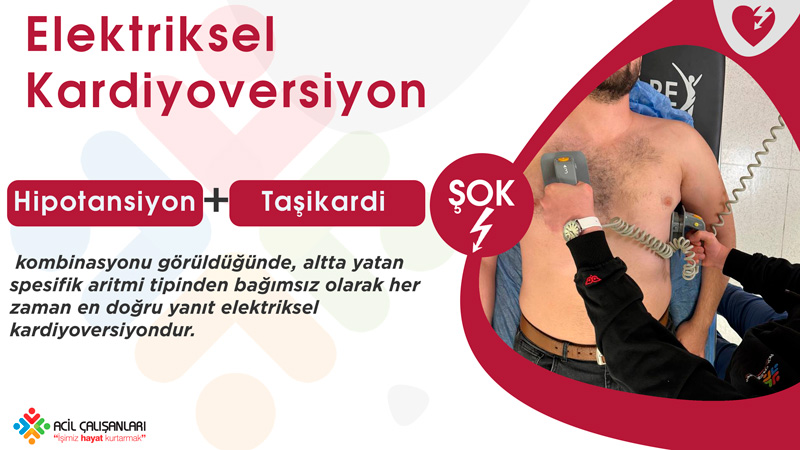 Senkronize Kardiyoversiyon