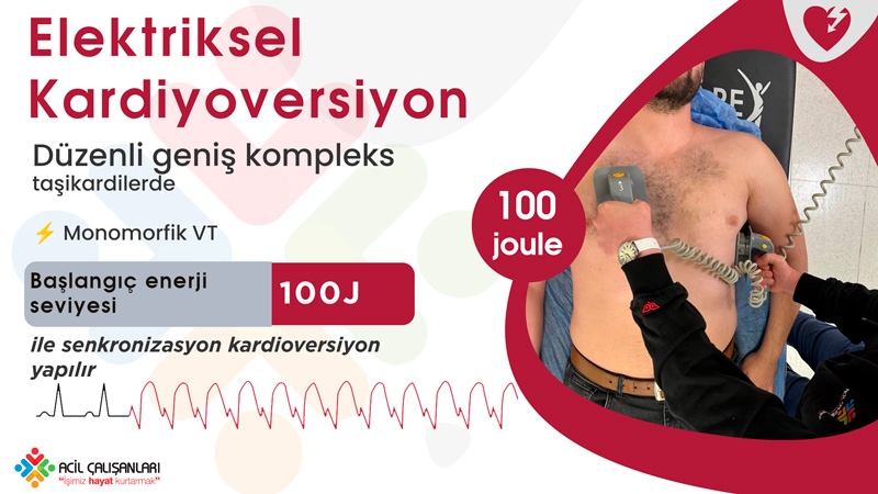 Düzenli Geniş Kompleks Taşikardi