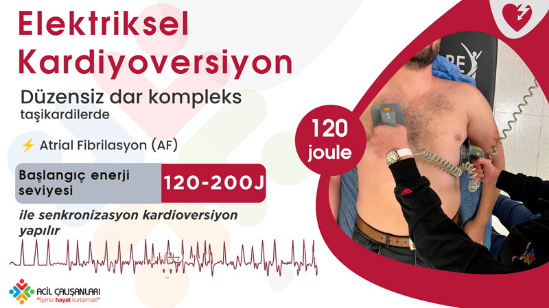 Düzensiz Dar Kompleks Taşikardi