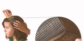 Bitlenme (Pediculosis) Acil Yaklaşım