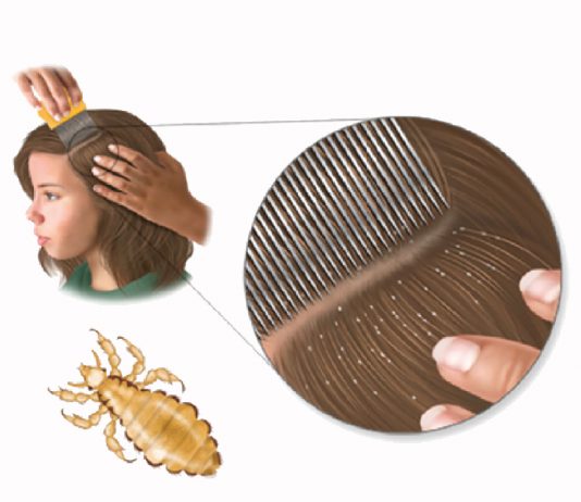 Bitlenme (Pediculosis) Acil Yaklaşım