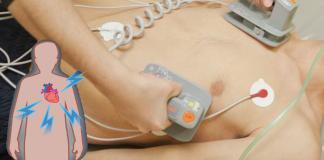 Elektriksel Kardiyoversiyon Uygulaması