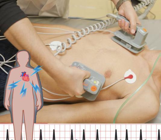 Elektriksel Kardiyoversiyon Uygulaması