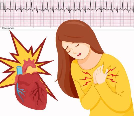 Supraventriküler Taşikardi (SVT) Acil Yaklaşım