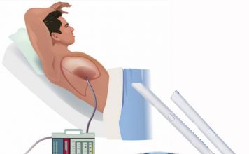 Göğüs Tüpü Takılması (Tüp Torakostomi)