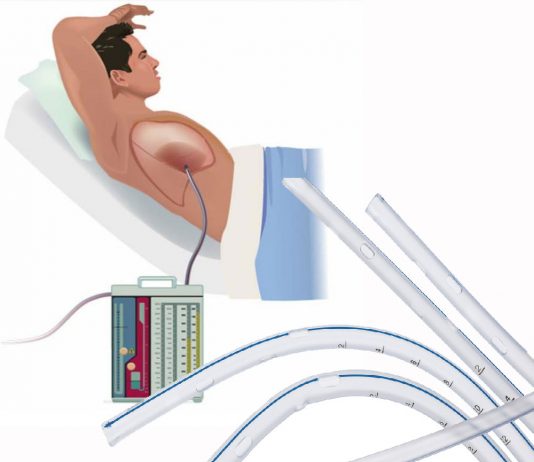 Göğüs Tüpü Takılması (Tüp Torakostomi)