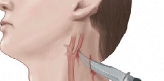 Penetran Boyun Yaralanmalarına Acil Yaklaşım