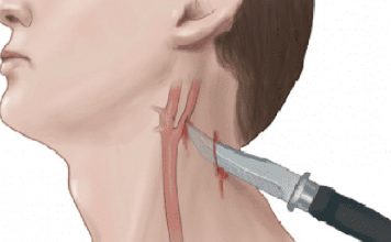 Penetran Boyun Yaralanmalarına Acil Yaklaşım