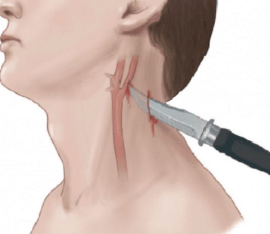 Penetran Boyun Yaralanmalarına Acil Yaklaşım