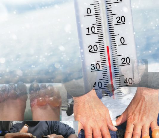 Soğuk Yaralanmalarına Acil Yaklaşım