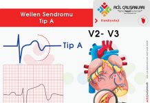Wellen Sendromu Acil Yaklaşım