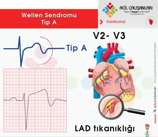 Wellen Sendromu Acil Yaklaşım