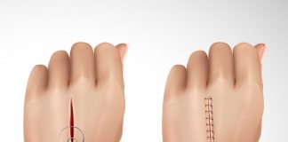 Kesi Süturasyonu Uygulaması