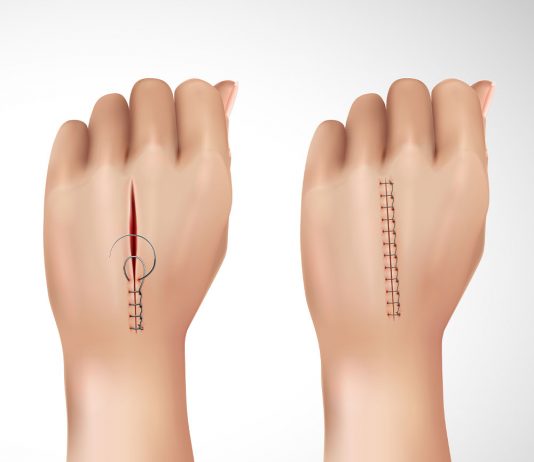 Kesi Süturasyonu Uygulaması