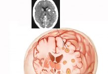Metastatik Beyin Tümörleri